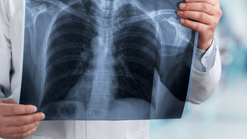 Szerbiában évente közel 7000 tüdőrákos esetet regisztrálnak - illusztráció